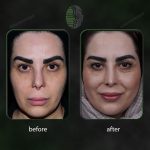 جراحی بینی ترمیمی در تهران