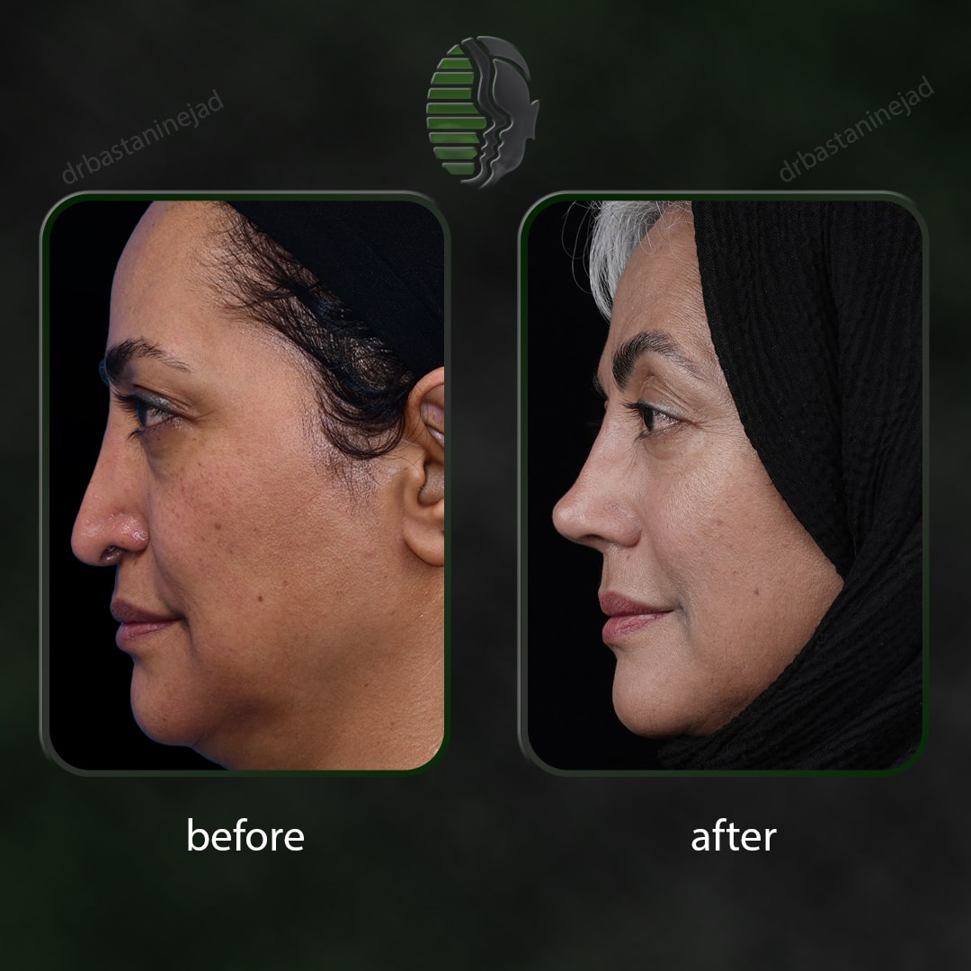 بتول شیخ شعاعی_سال3_ترمیم_نیم رخ2-min