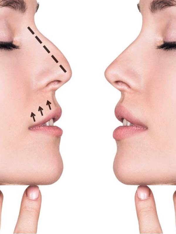 مقایسه جراحی بینی با لیزر و روش‌های دیگر