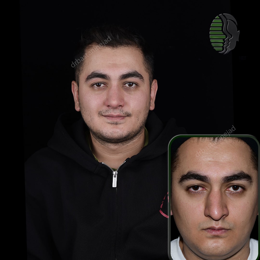 مهیار قلی زاده_ماه3_اولیه_رو به رو-min