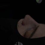 جراحی بینی ترمیمی در تهران