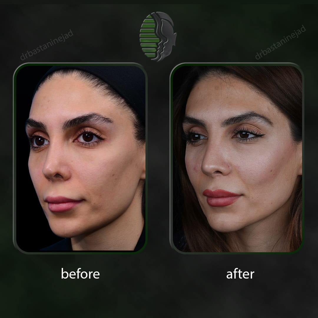 تصویر قبل و بعد از جراحی بینی پس از 1 سال