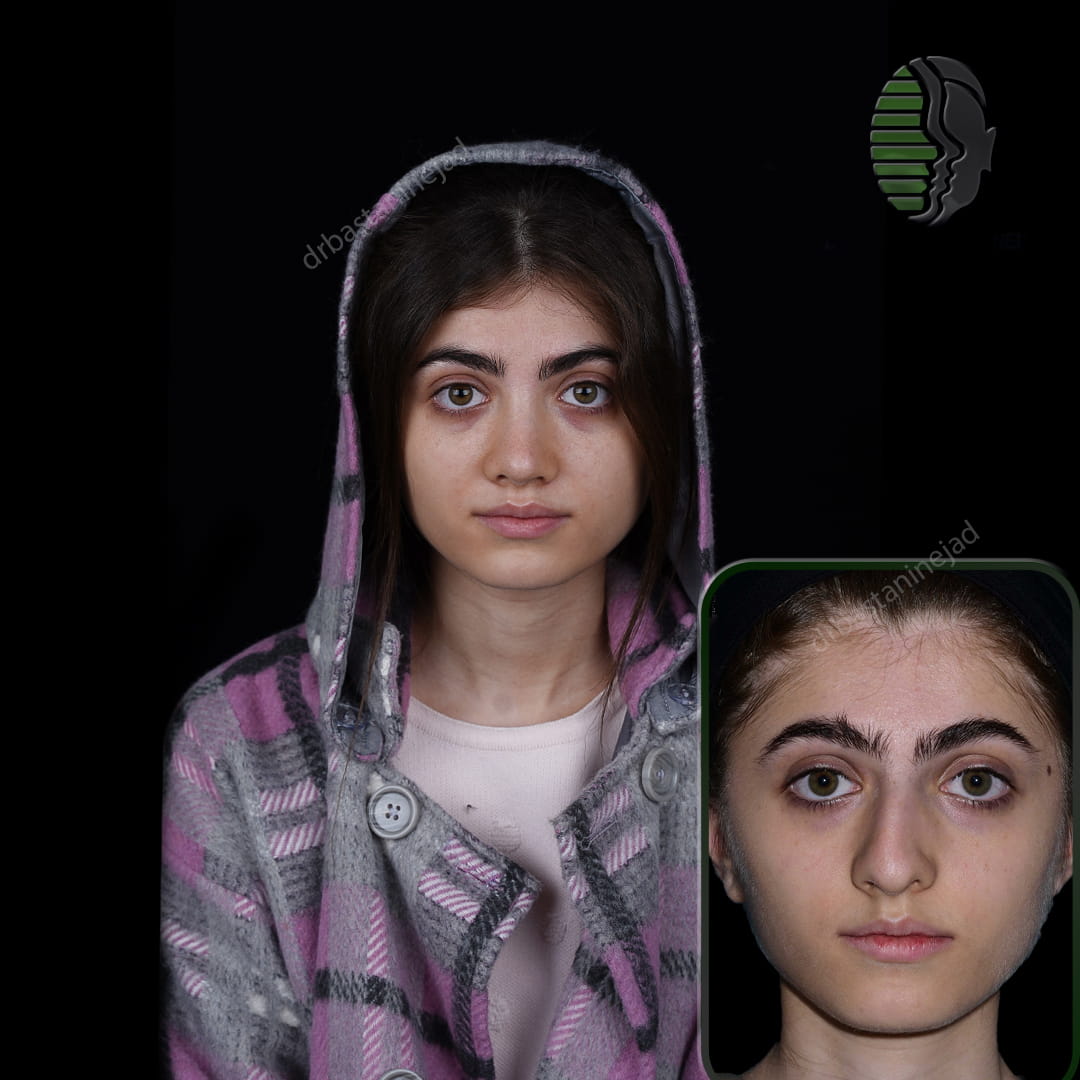 تصویر قبل و بعد از جراحی بینی پس از 5 ماه