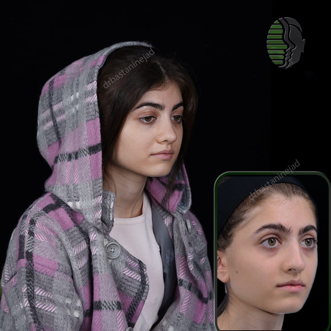 تصویر قبل و بعد از جراحی بینی پس از 5 ماه