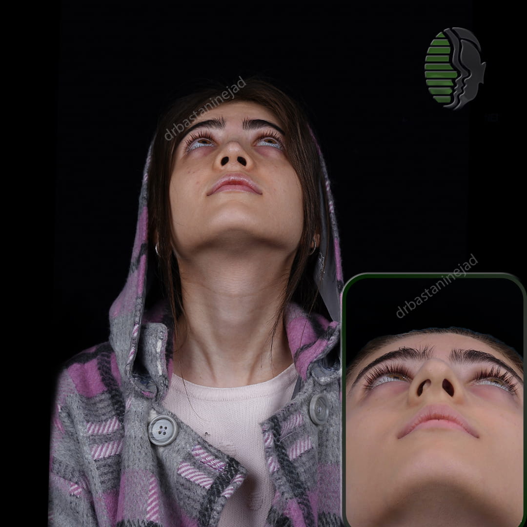 تصویر قبل و بعد از جراحی بینی پس از 5 ماه