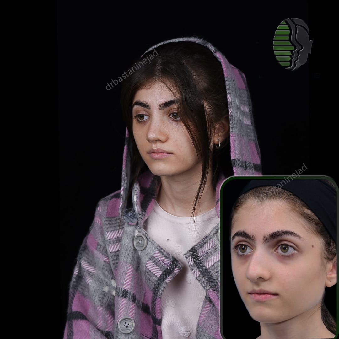 تصویر قبل و بعد از جراحی بینی پس از 5 ماه