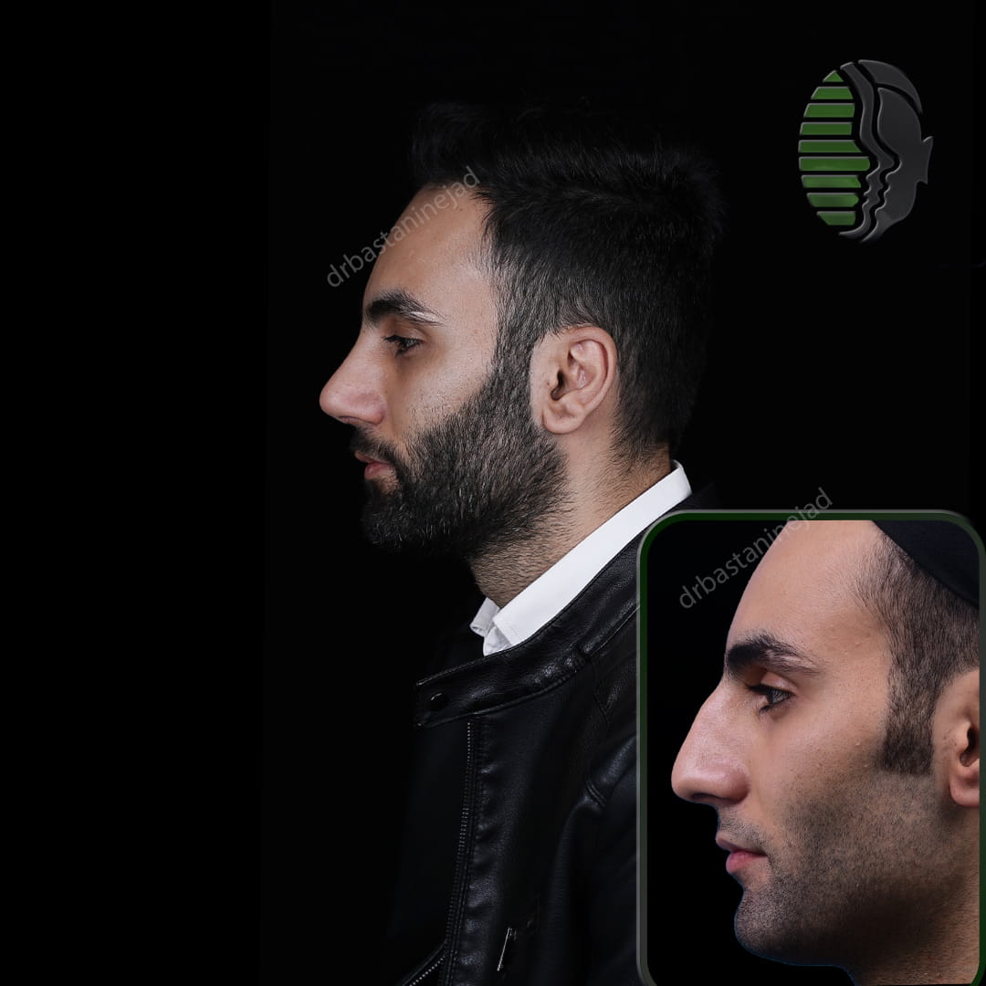 تصویر قبل و بعد از جراحی بینی پس از 2 سال