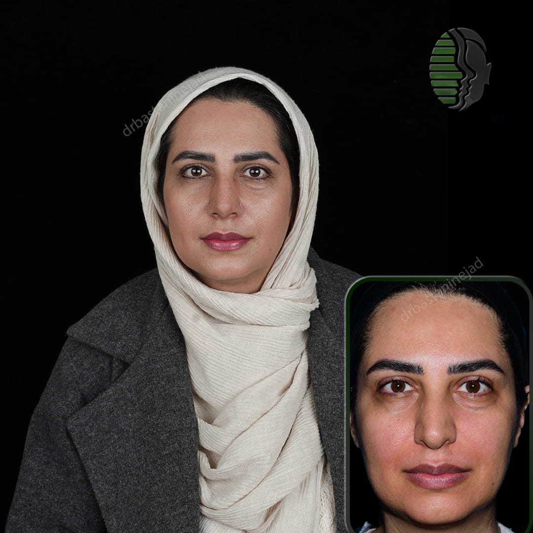 تصویر قبل و بعد از جراحی بینی پس از یک ماه