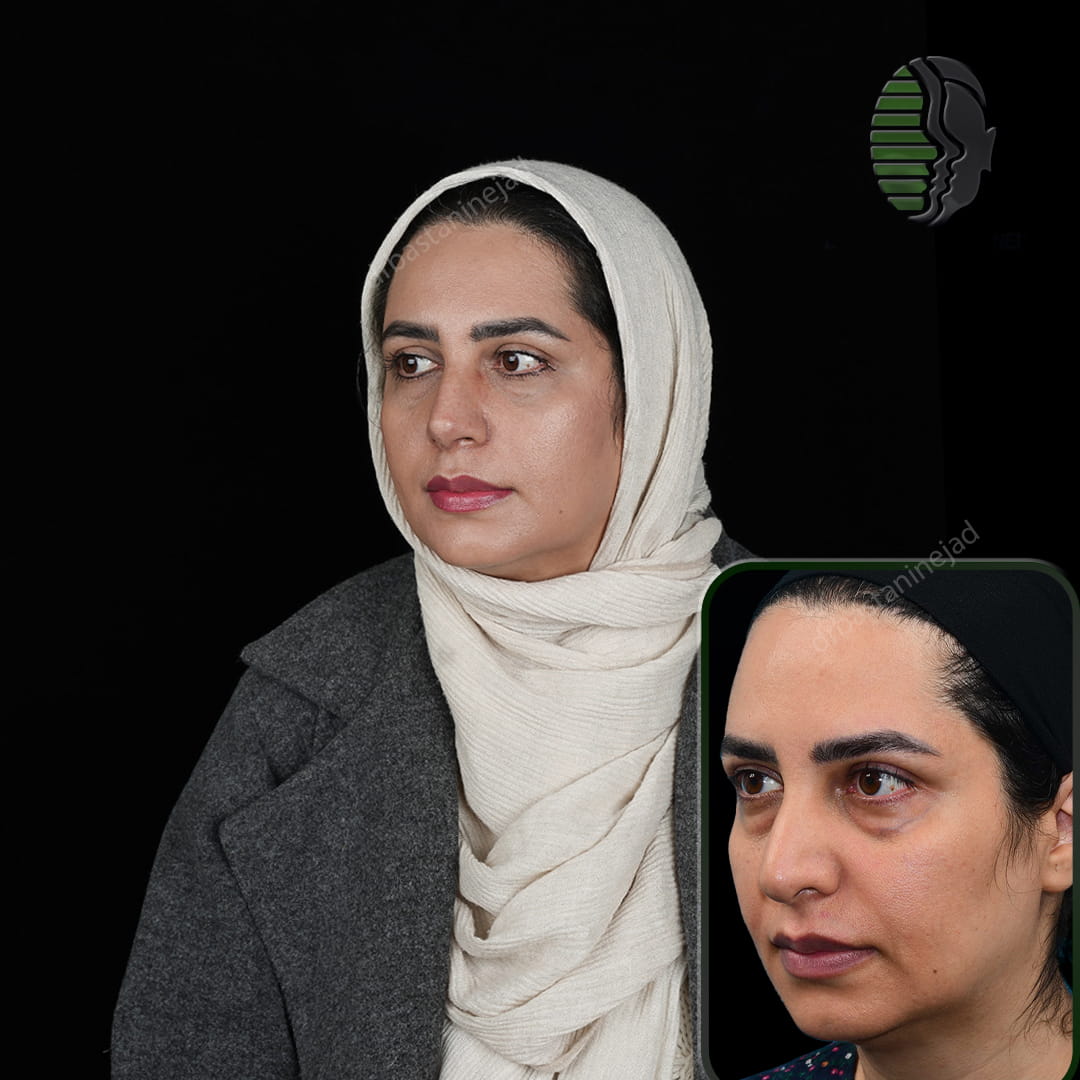 تصویر قبل و بعد از جراحی بینی پس از یک ماه