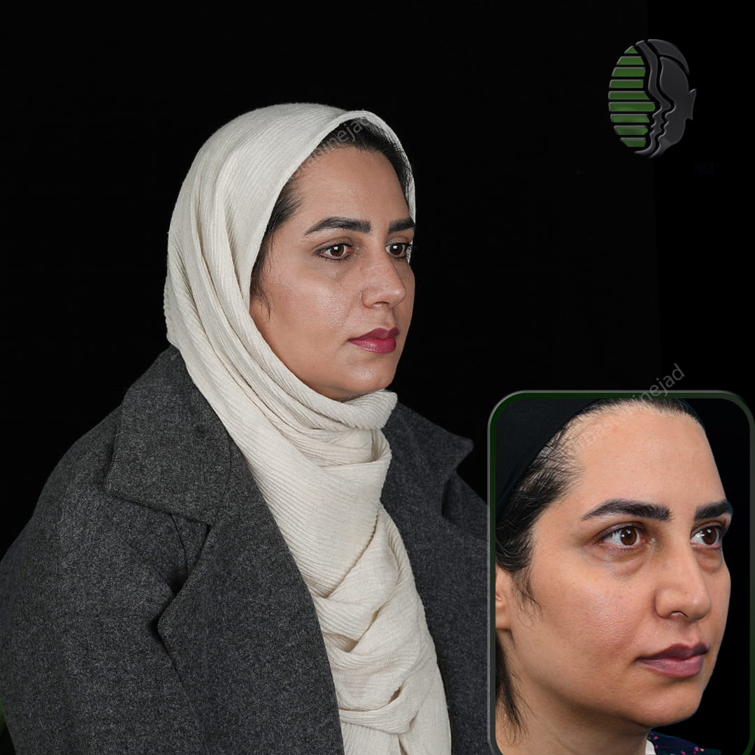 تصویر قبل و بعد از جراحی بینی پس از یک ماه