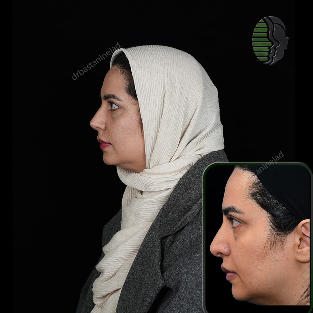 تصویر نیم رخ قبل و بعد از جراحی بینی