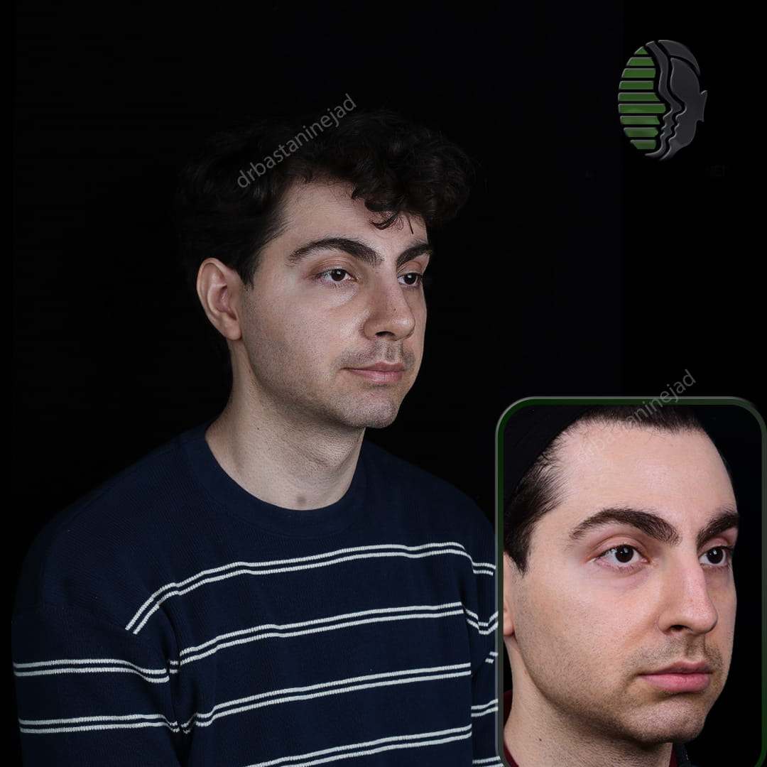 تصویر قبل و بعد از جراحی بینی پس از یک ماه