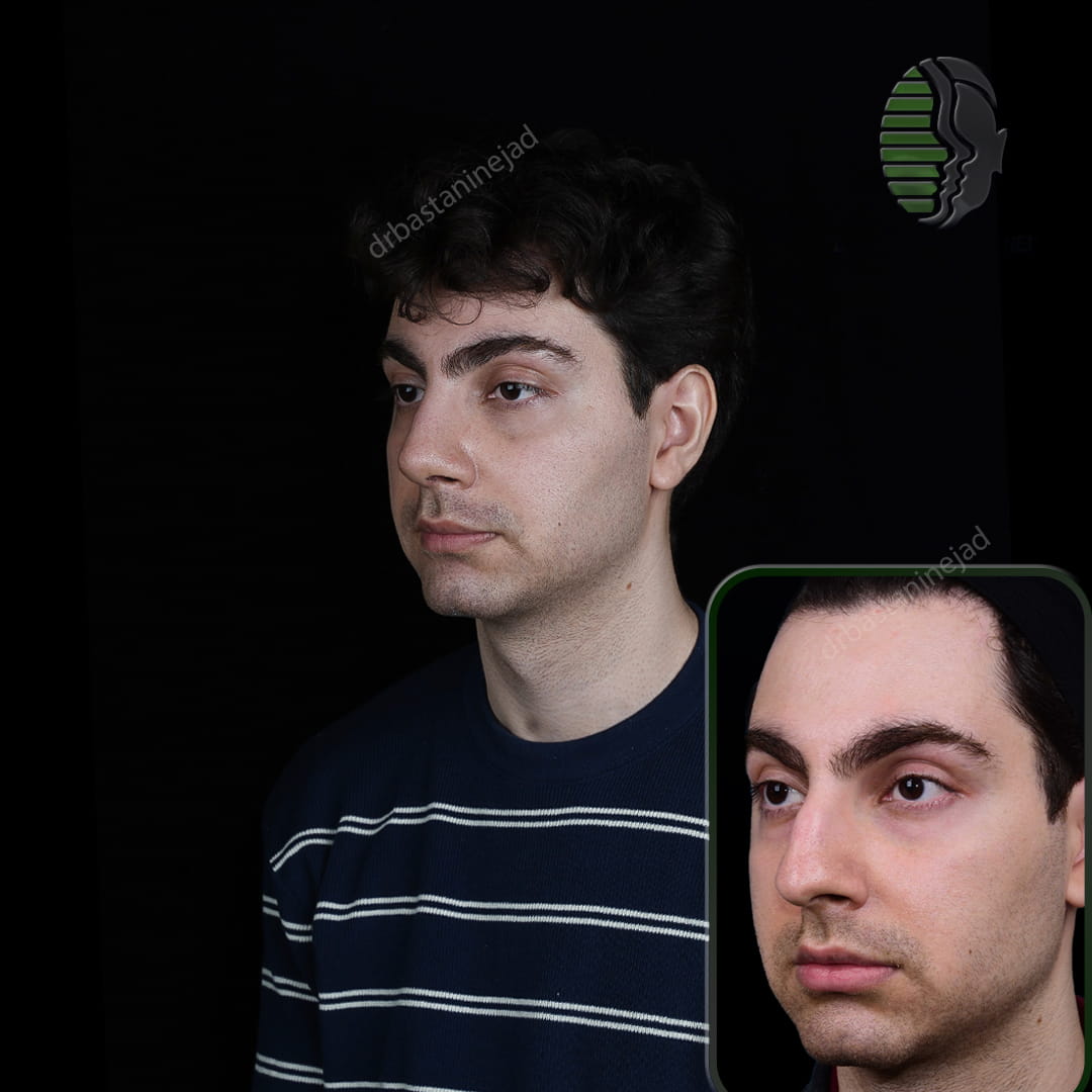 تصویر قبل و بعد از جراحی بینی پس از یک ماه