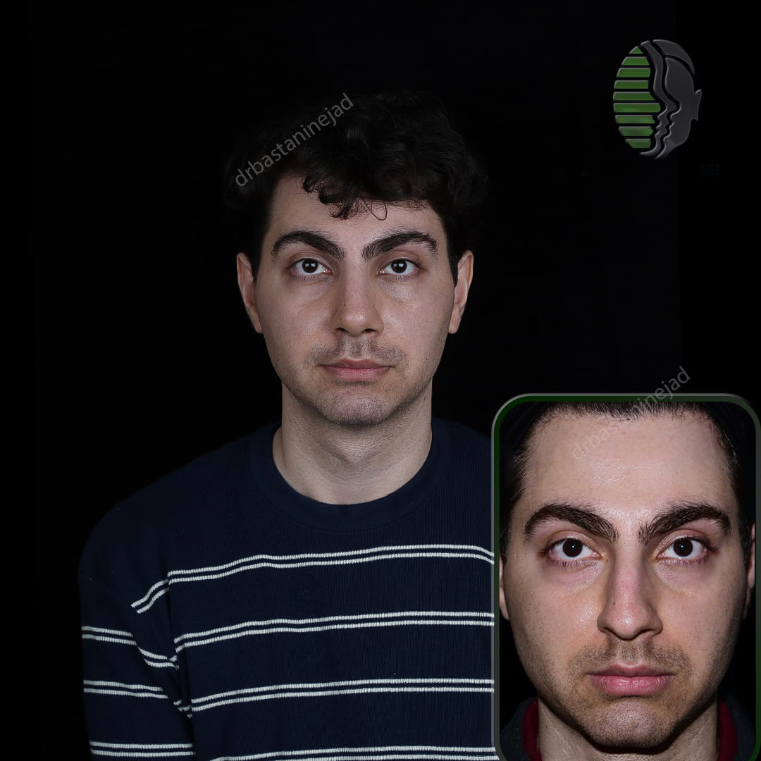 تصویر قبل و بعد از جراحی بینی پس از یک ماه