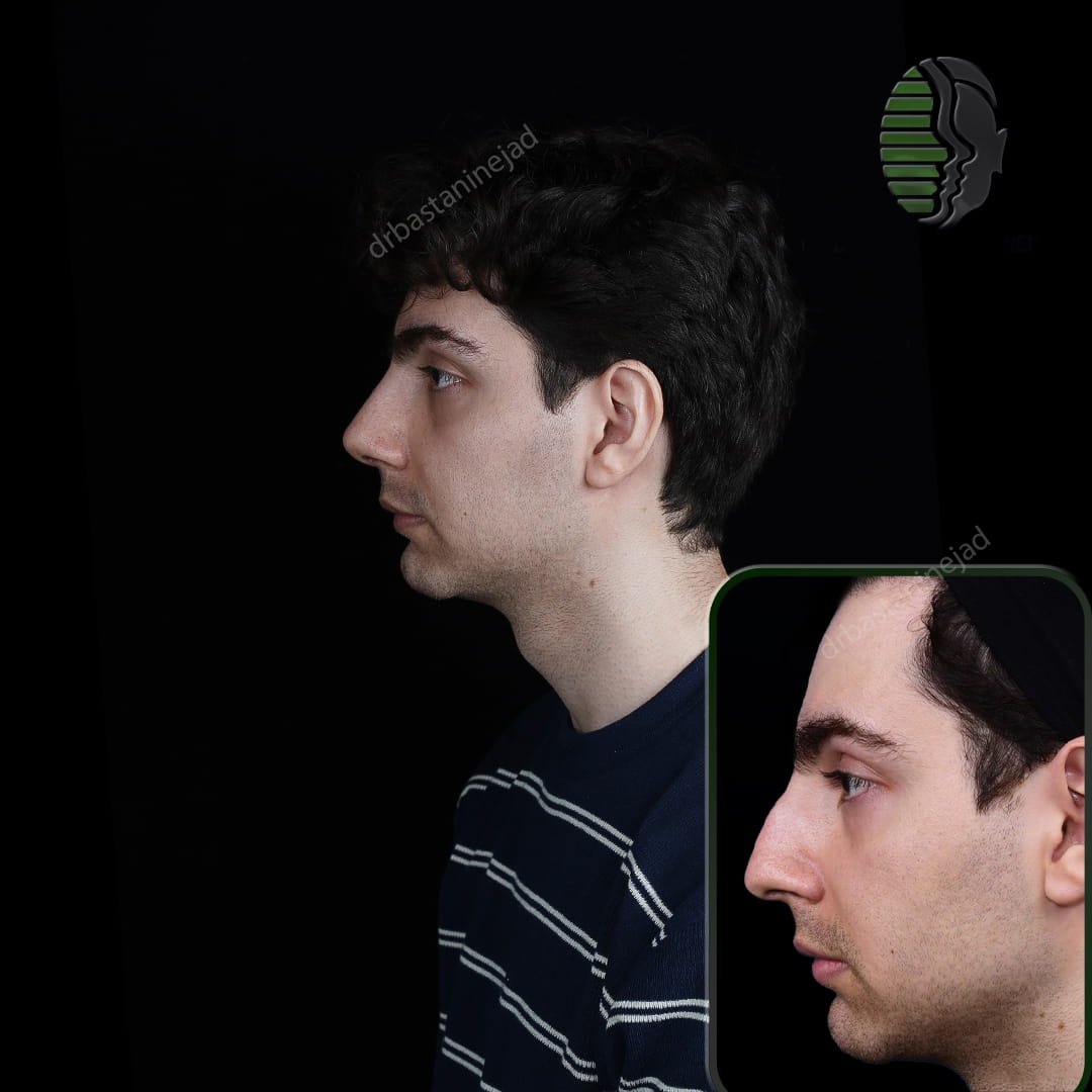 تصویر قبل و بعد از جراحی بینی پس از یک ماه