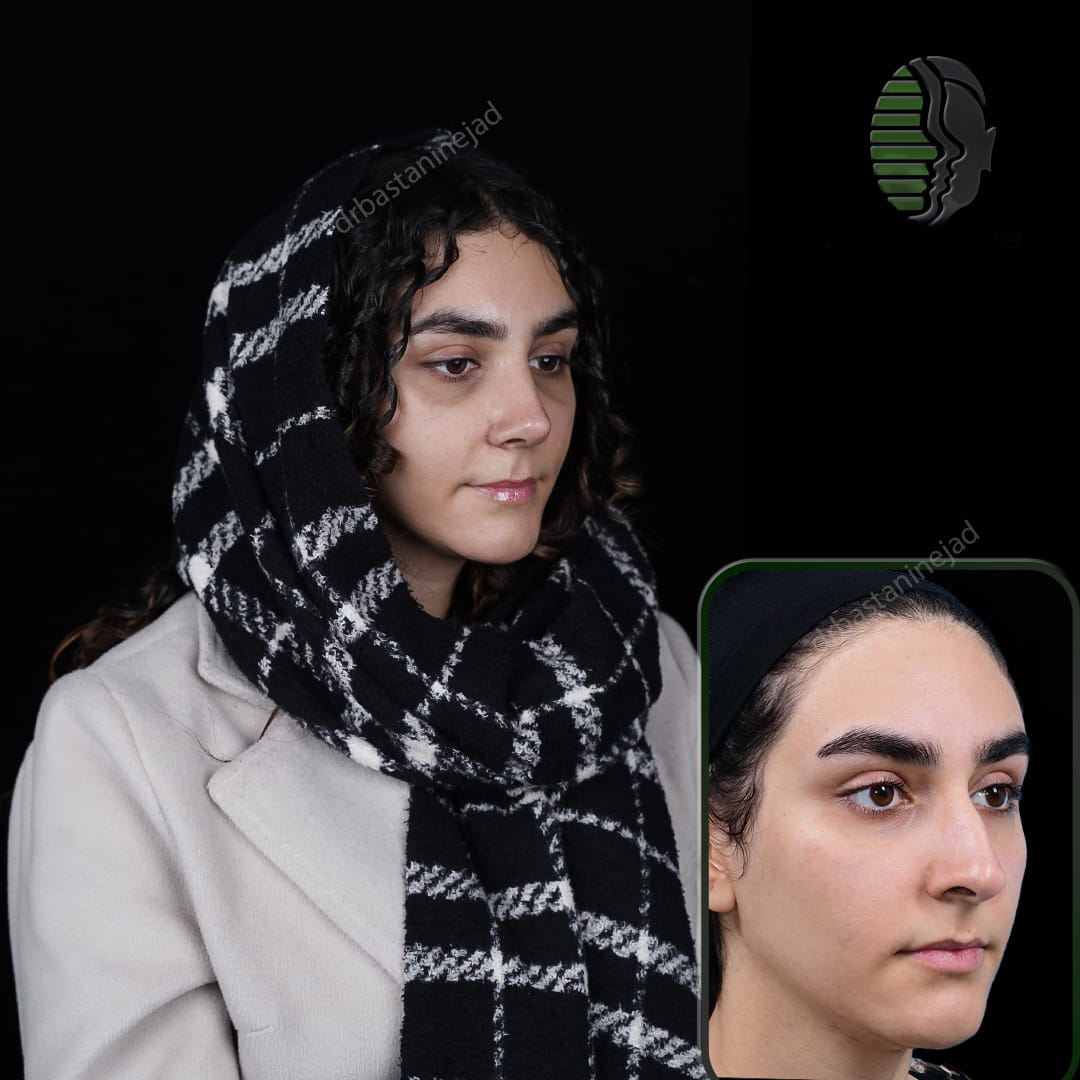 تصویر قبل و بعد از جراحی بینی پس از یک ماه