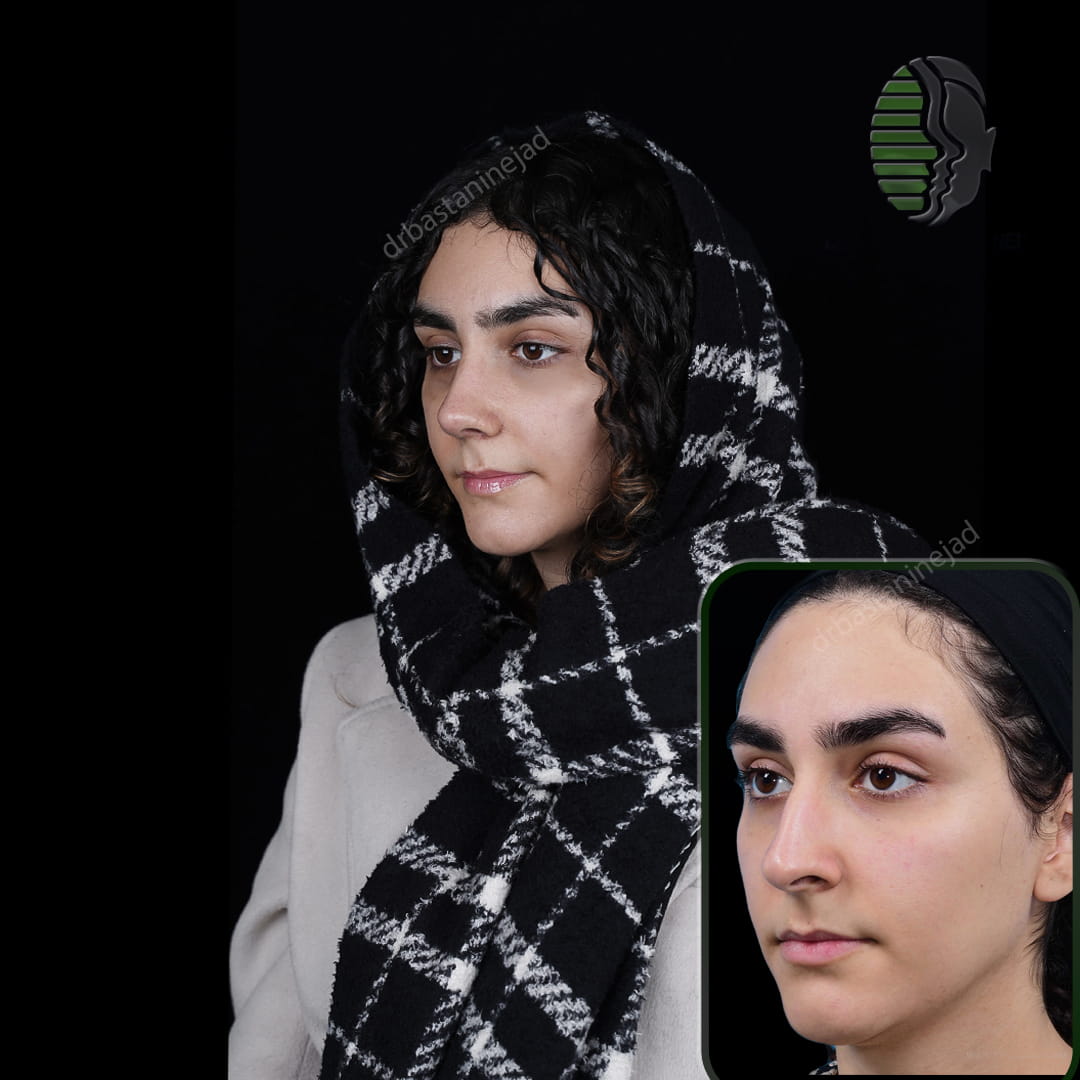 تصویر قبل و بعد از جراحی بینی پس از یک ماه