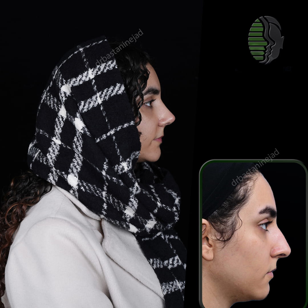 تصویر قبل و بعد از جراحی بینی پس از یک ماه
