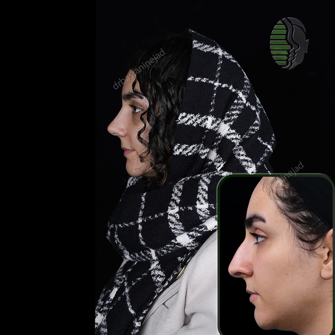 تصویر قبل و بعد از جراحی بینی پس از یک ماه
