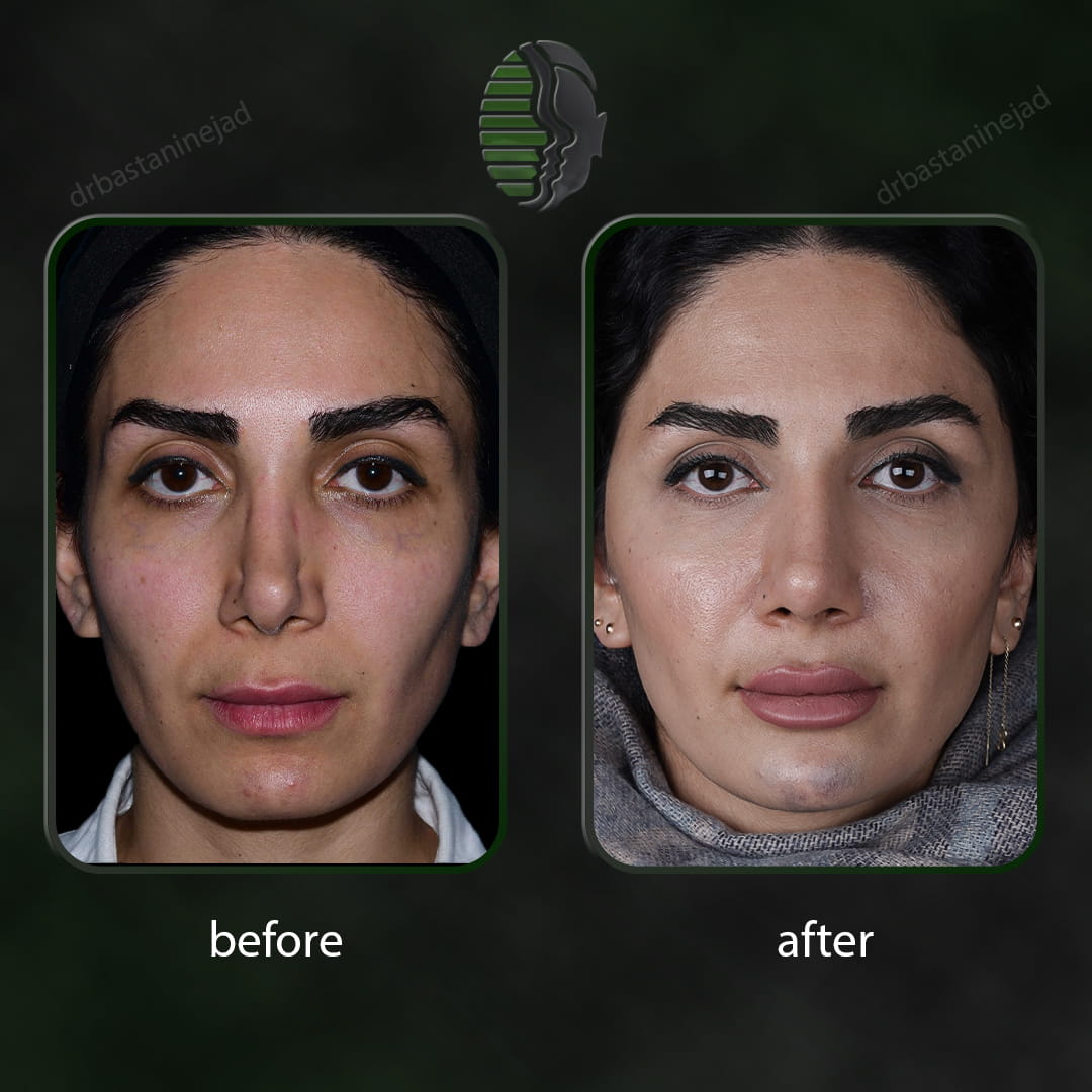 تصویر قبل و بعد از عمل ترمیمی بینی پس از 7 ماه