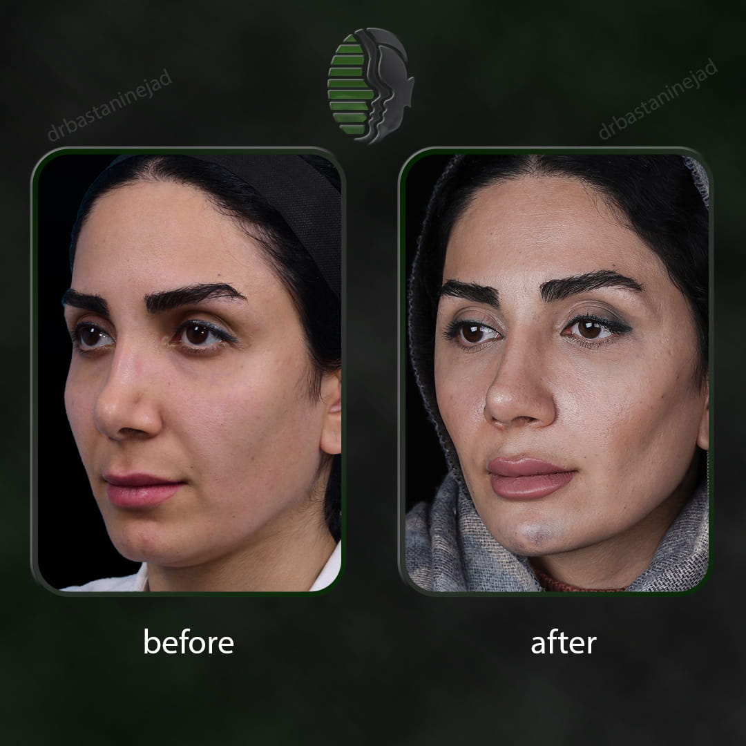 تصویر قبل و بعد از عمل ترمیمی بینی پس از 7 ماه