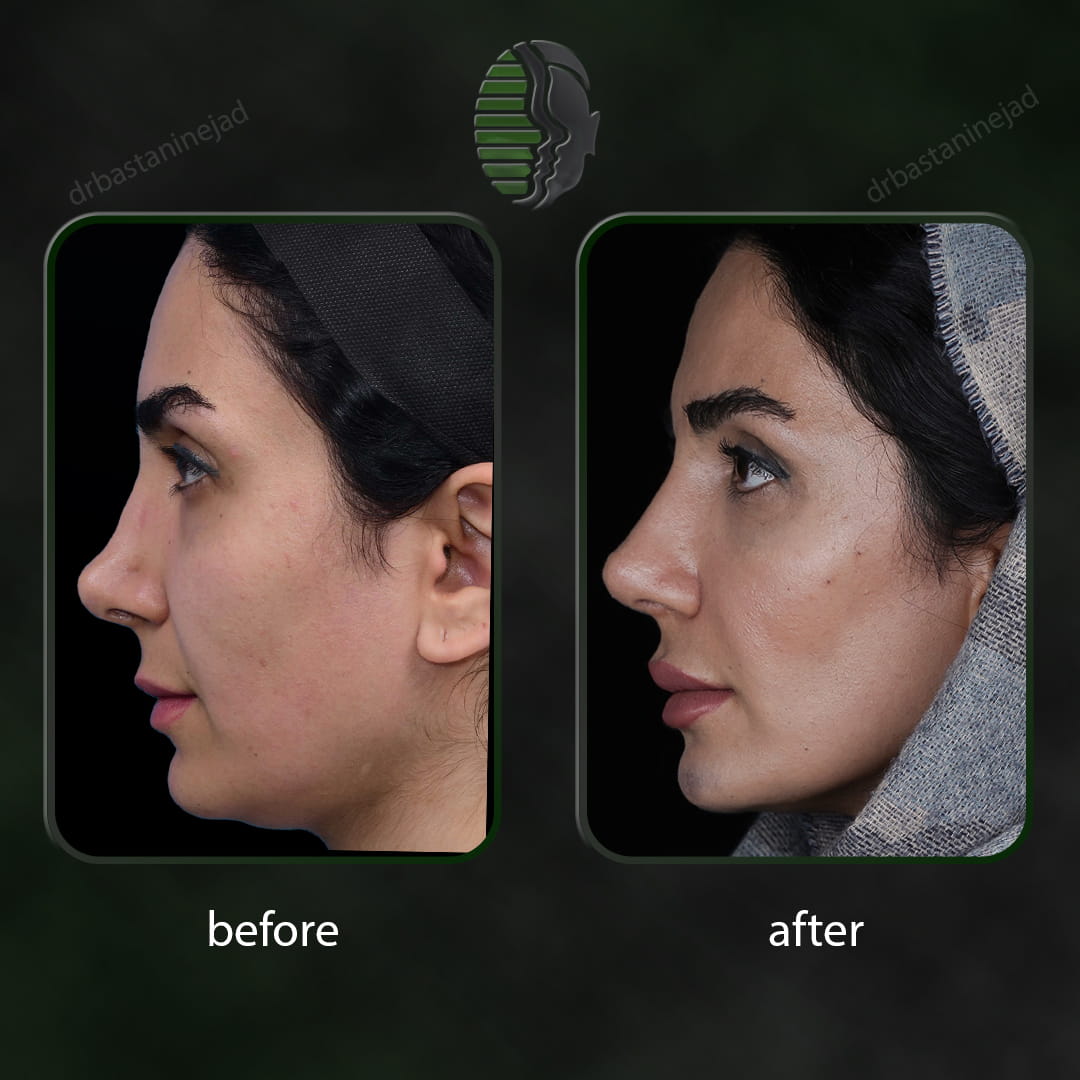تصویر قبل و بعد از عمل ترمیمی بینی پس از 7 ماه