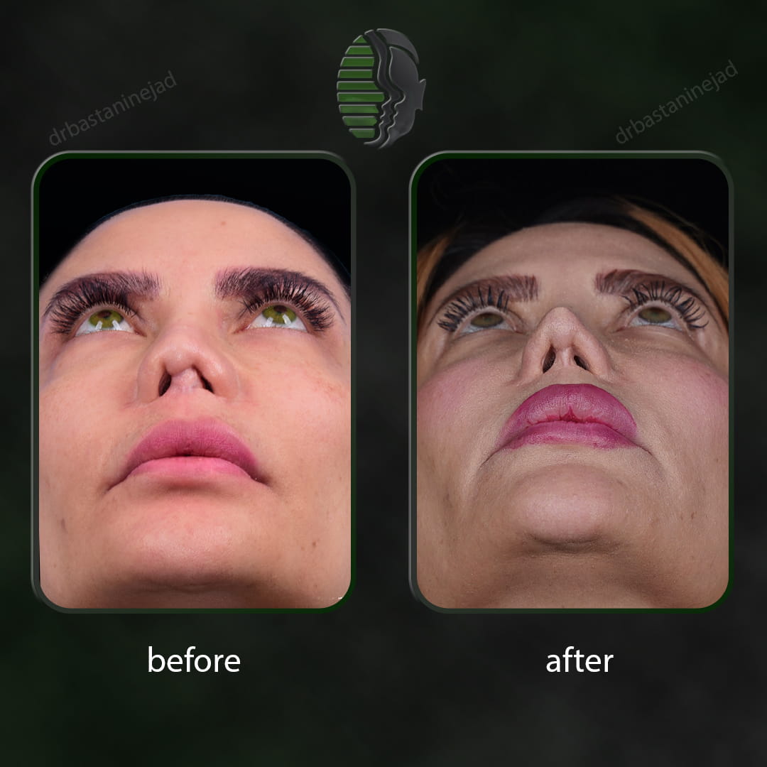 تصویر قبل و بعد از عمل ترمیمی بینی پس از 2 سال