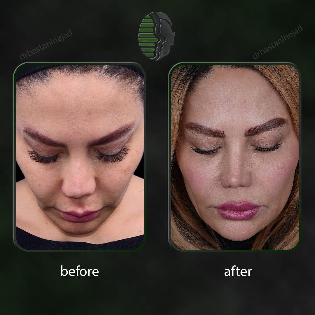 تصویر قبل و بعد از عمل ترمیمی بینی پس از 2 سال