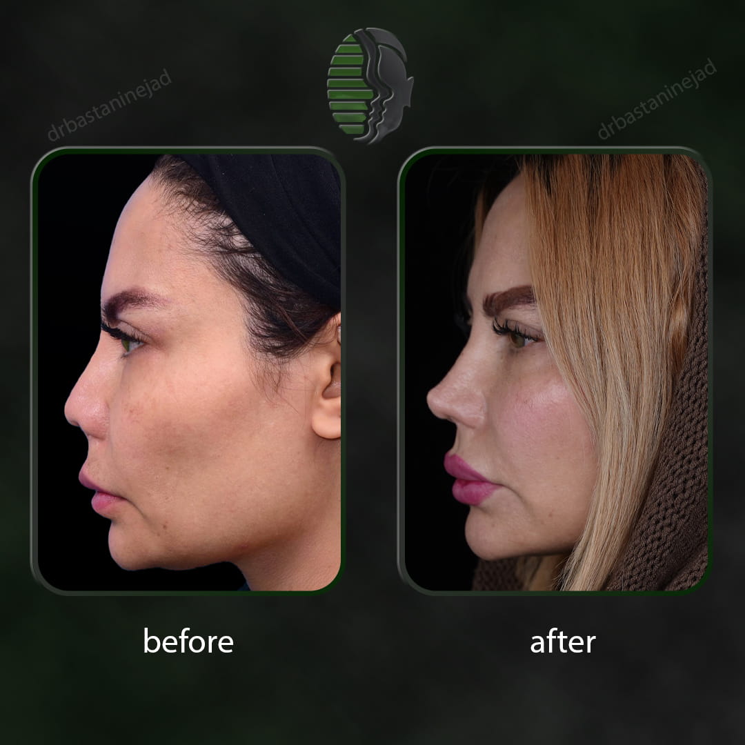 تصویر قبل و بعد از عمل ترمیمی بینی پس از 2 سال