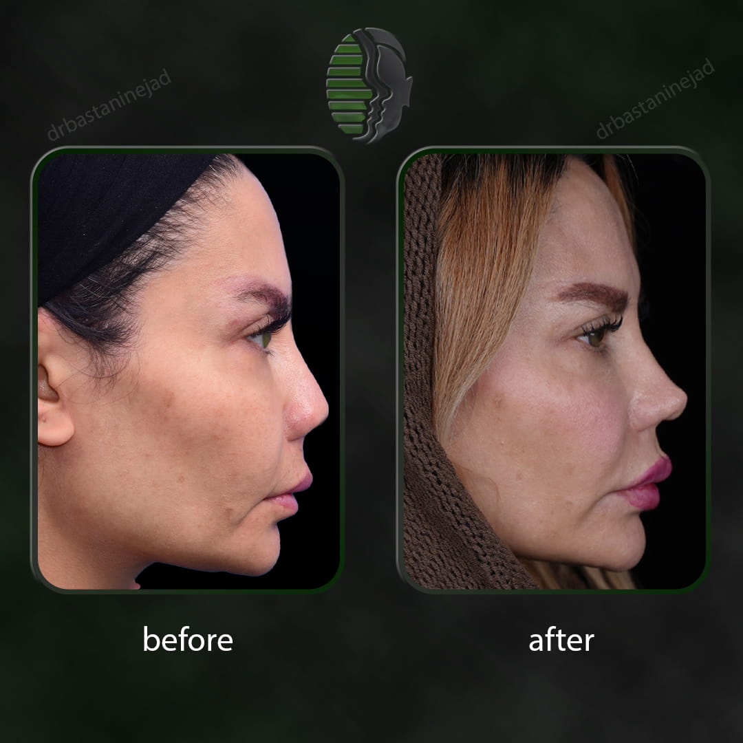 تصویر قبل و بعد از عمل ترمیمی بینی پس از 2 سال