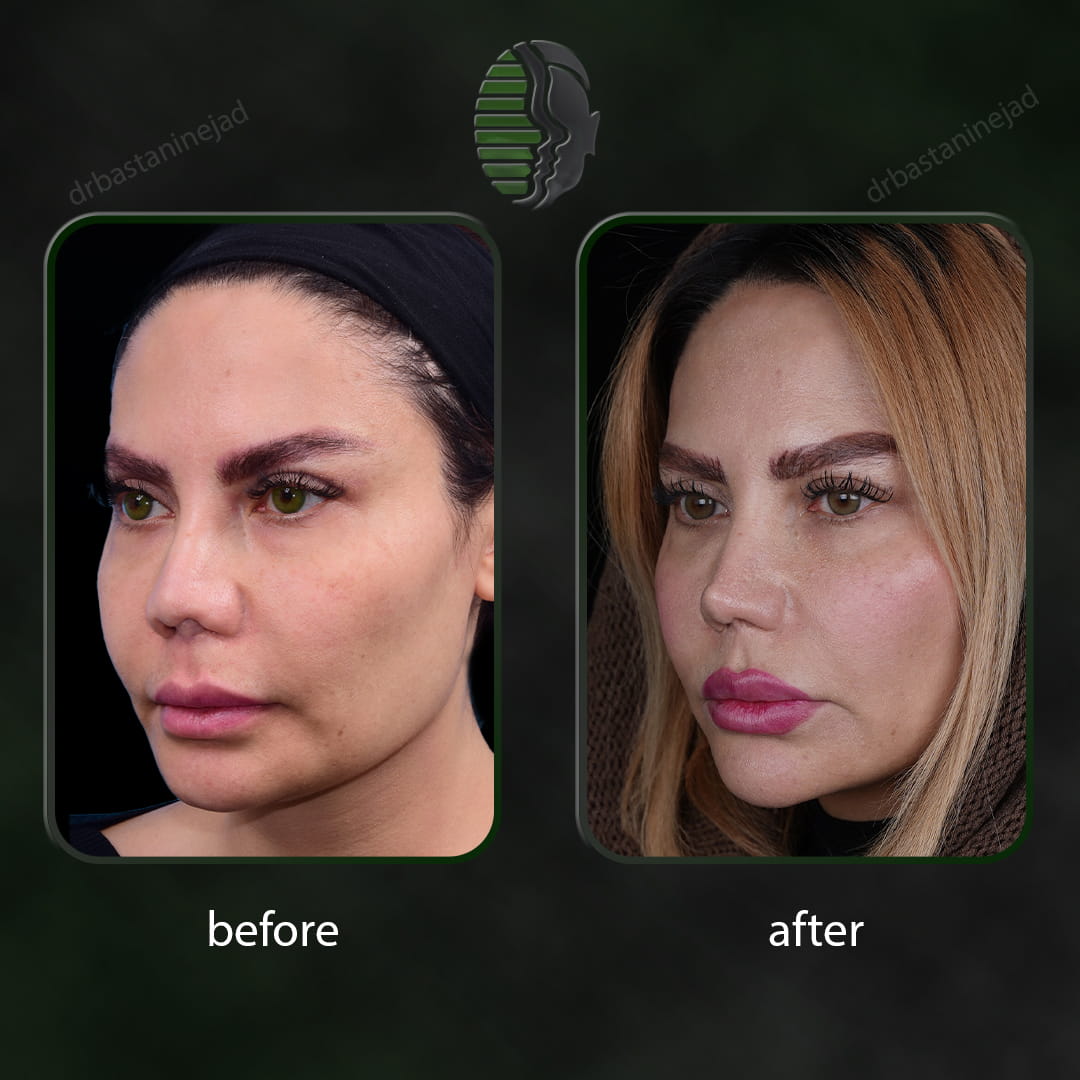 تصویر قبل و بعد از عمل ترمیمی بینی پس از 2 سال