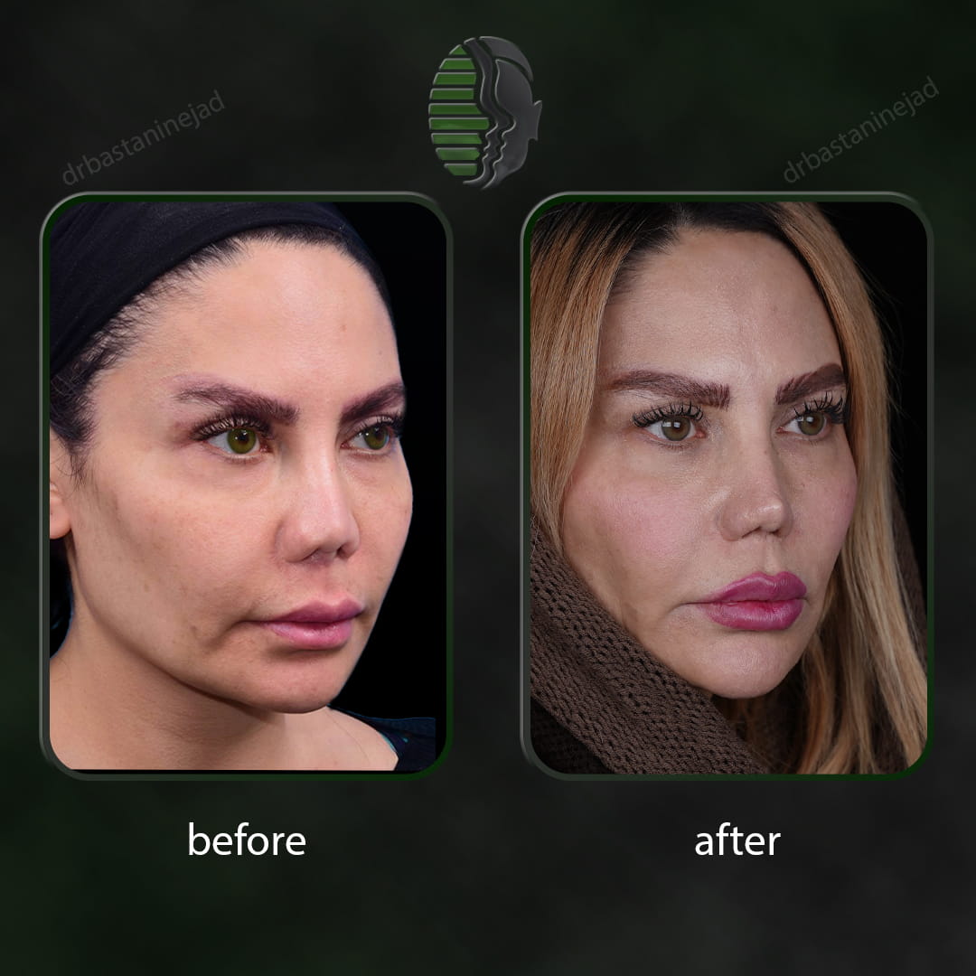 تصویر قبل و بعد از عمل ترمیمی بینی پس از 2 سال