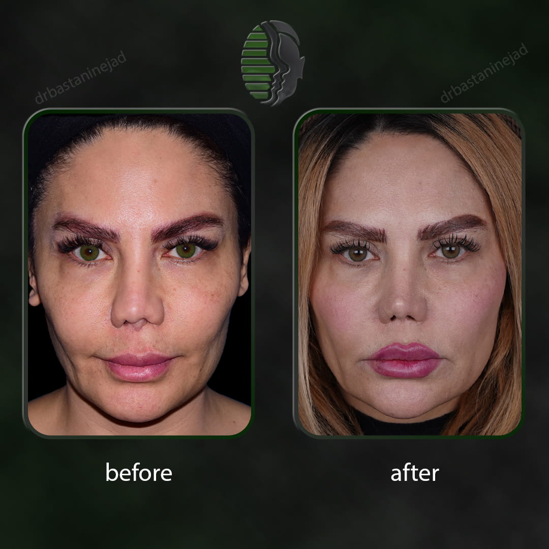 تصویر قبل و بعد از عمل ترمیمی بینی پس از 2 سال