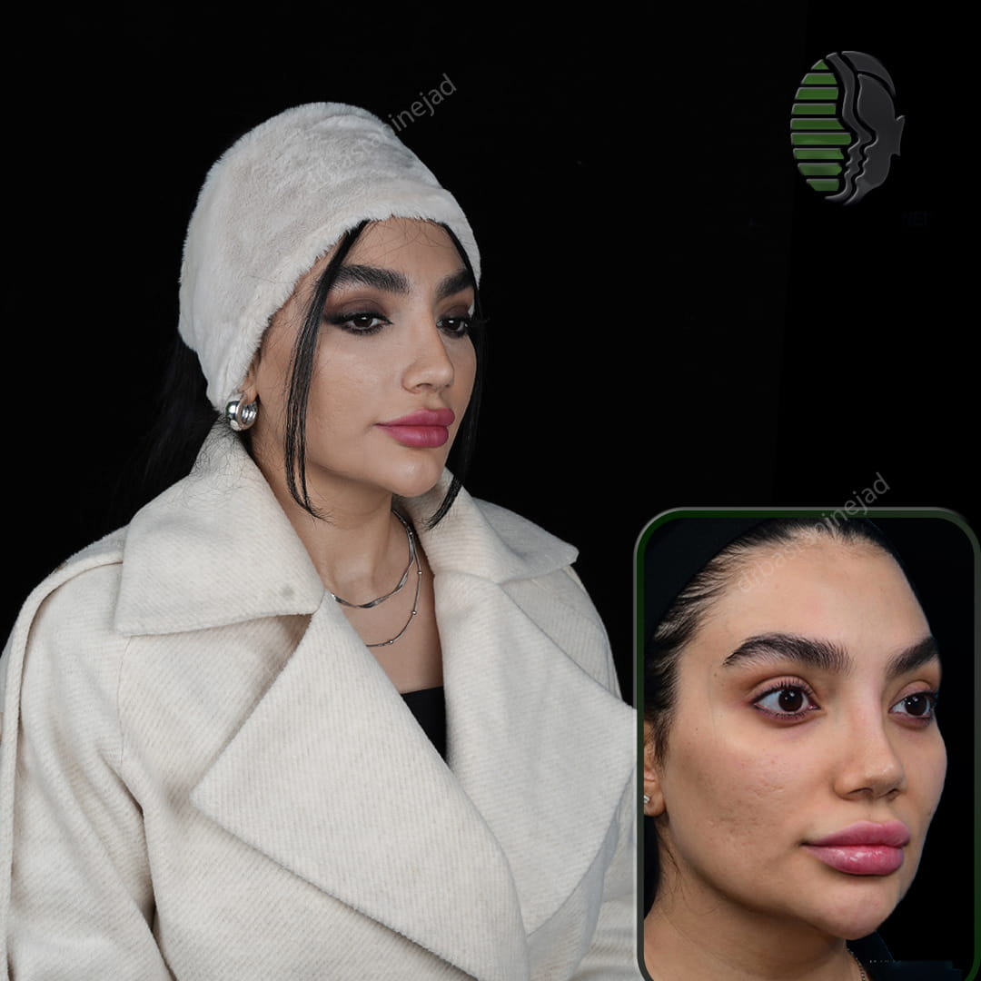 تصویر قبل و بعد از عمل بینی