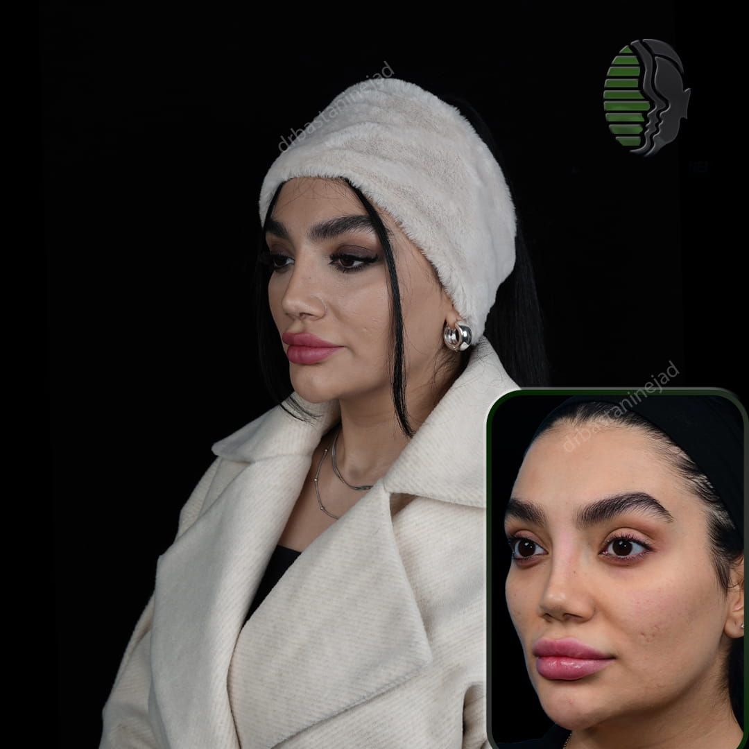 تصویر قبل و بعد از عمل بینی پس از سه ماه