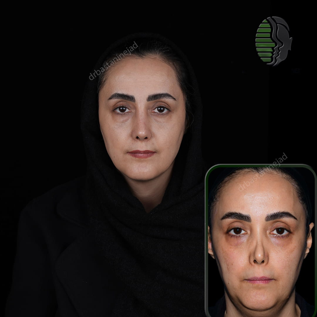 تصویر قبل و بعد از عمل ترمیمی بینی پس از سه ماه