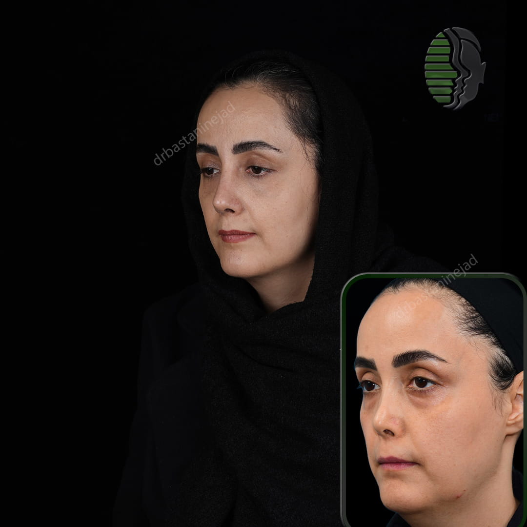 تصویر قبل و بعد از عمل ترمیمی بینی پس از سه ماه