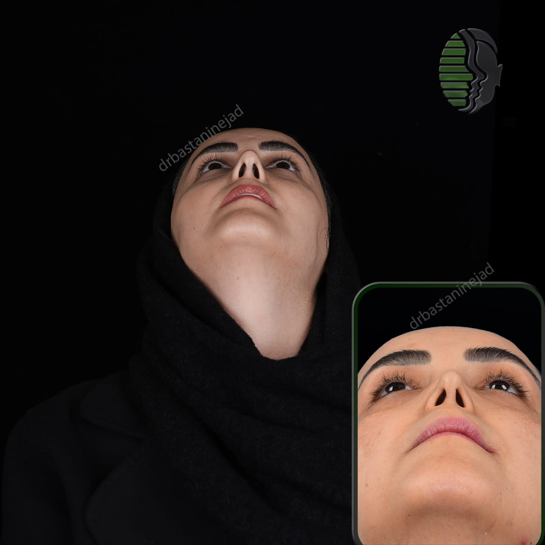 تصویر قبل و بعد از عمل ترمیمی بینی پس از سه ماه