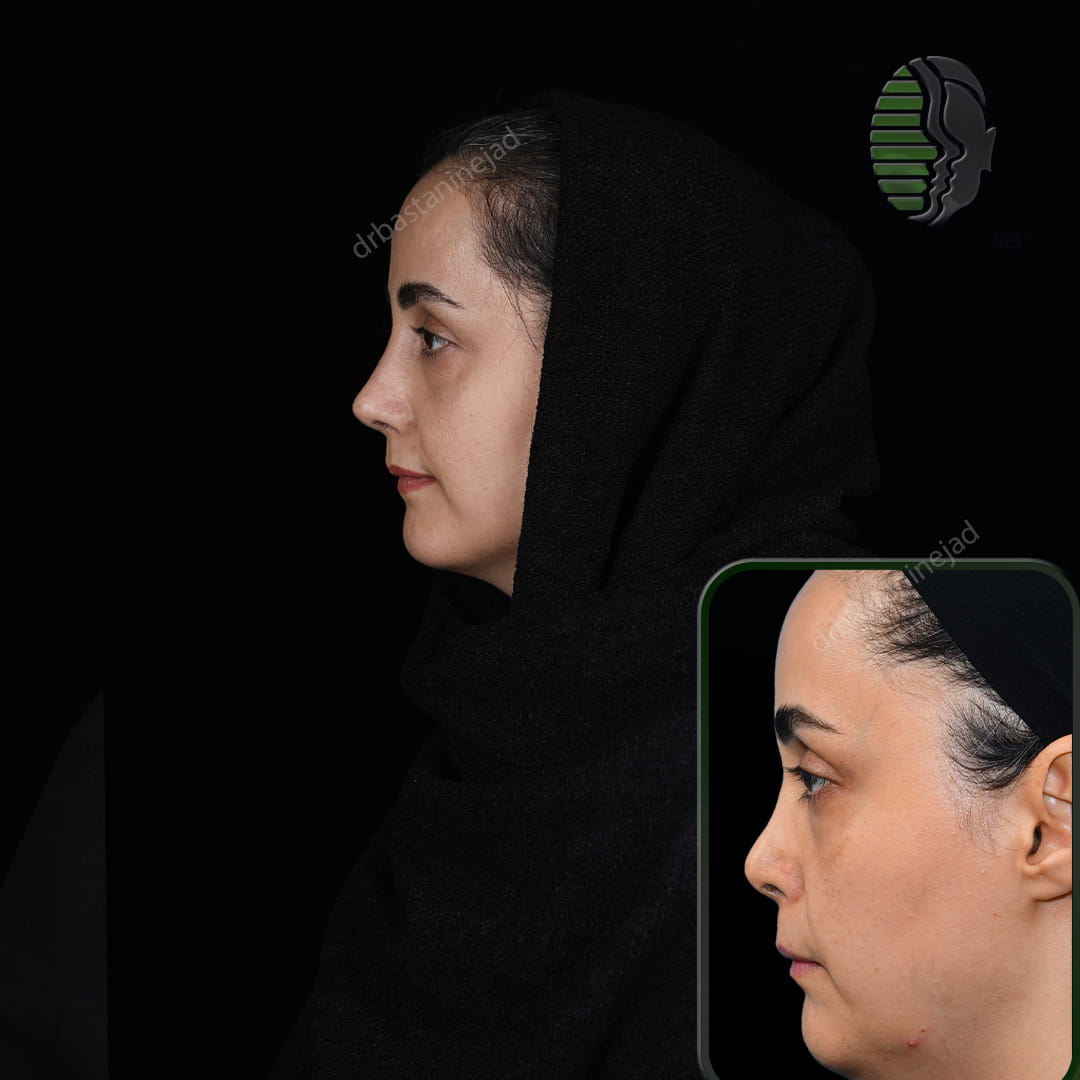 تصویر قبل و بعد از عمل ترمیمی بینی پس از سه ماه