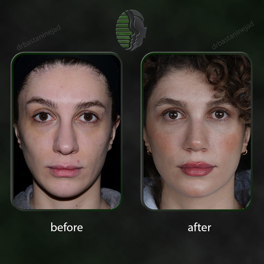تصویر قبل و بعد از جراحی بینی پس از یک سال