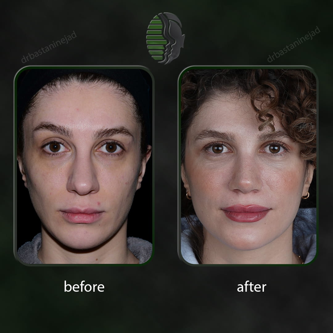 تصویر قبل و بعد از جراحی بینی پس از یک سال