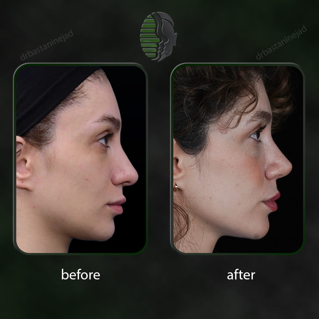 تصویر قبل و بعد از جراحی بینی پس از یک سال