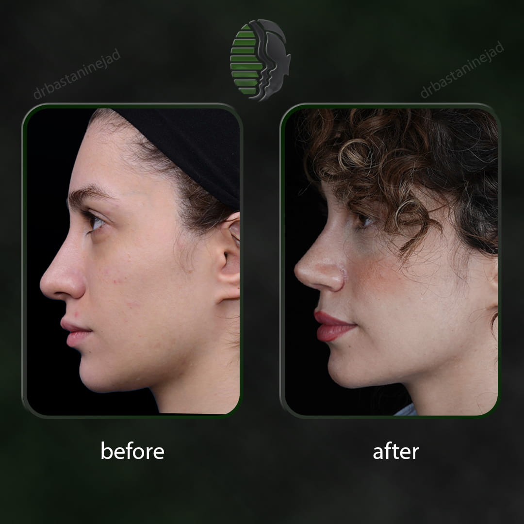 تصویر قبل و بعد از جراحی بینی پس از یک سال