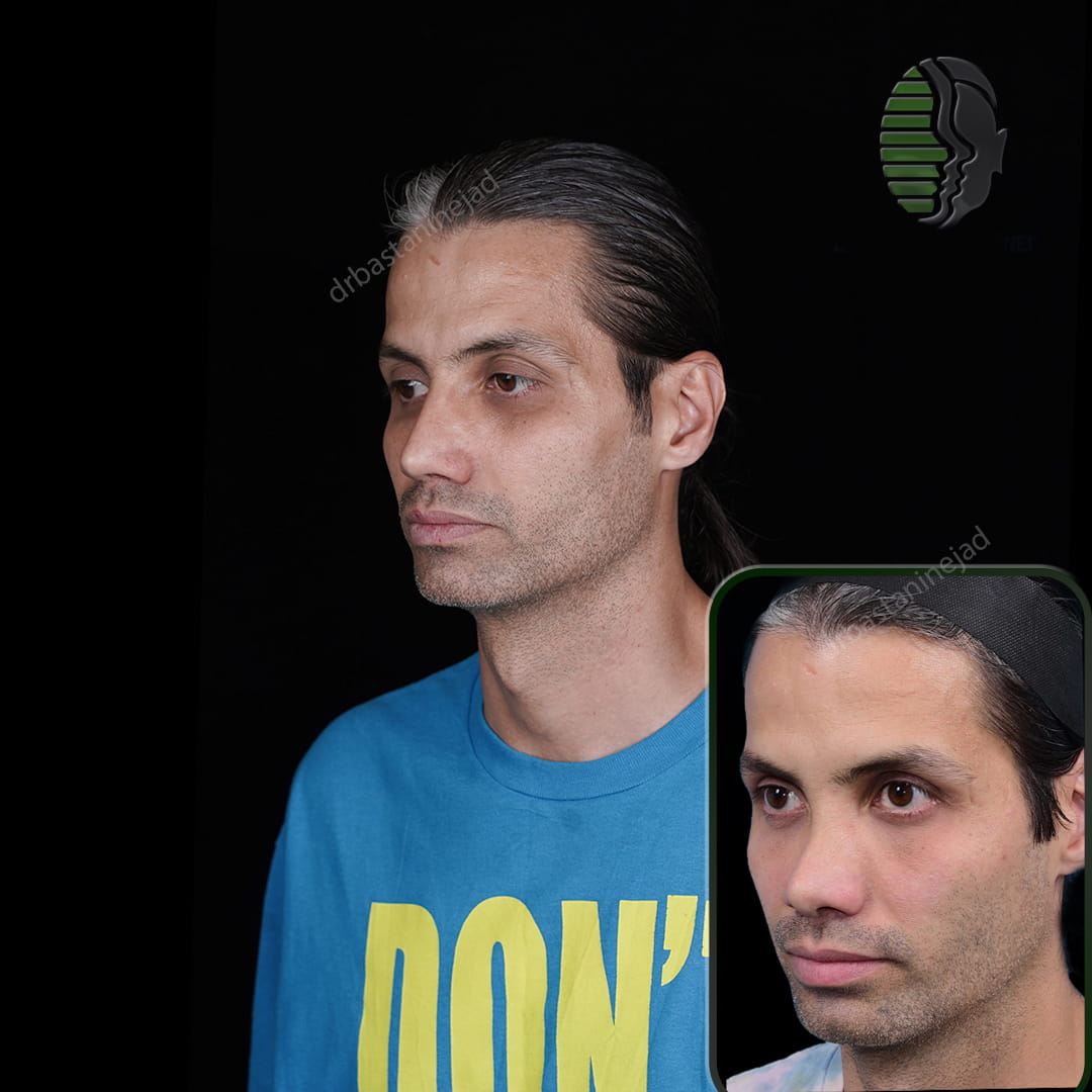 جراحی بینی ترمیمی دو مرحله - دکتر باستانی نژاد