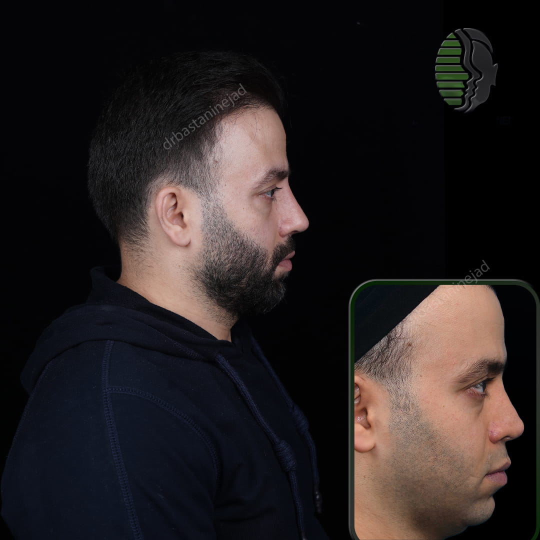 عکس سه رخ قبل و بعد از جراحی ترمیمی بینی