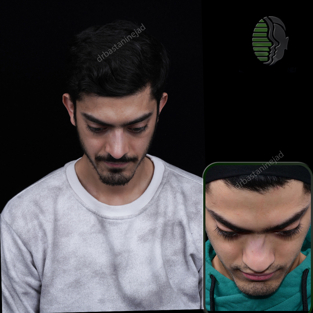 تصاویر قبل و بعد از جراحی بینی رفع انحراف پس از 3 ماه