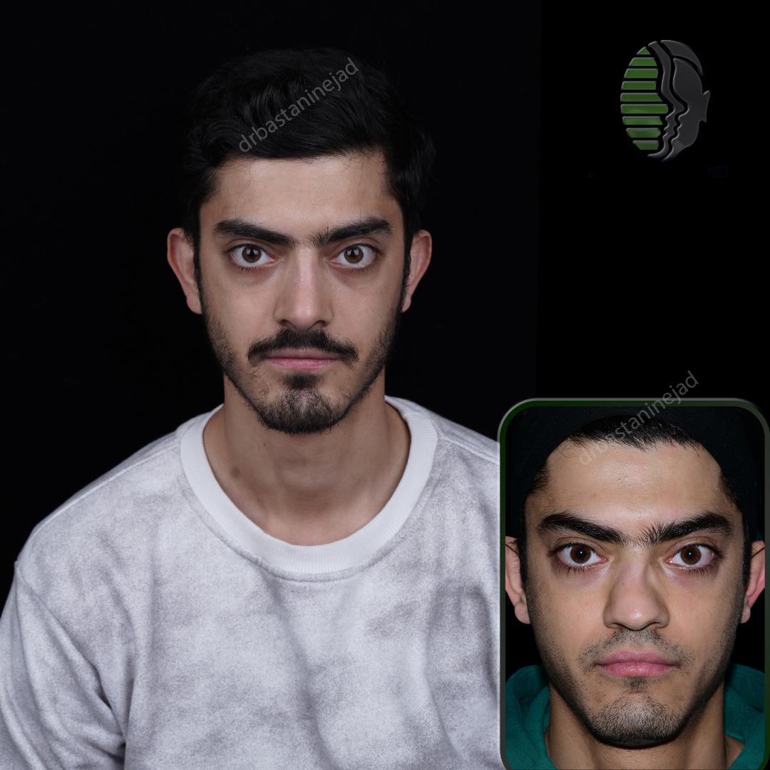 تصاویر قبل و بعد از جراحی بینی رفع انحراف پس از 3 ماه