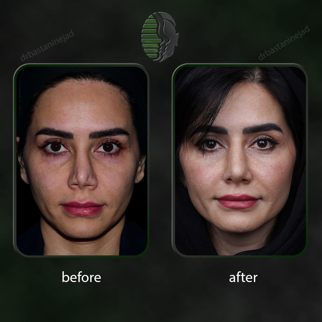جراحی بینی ترمیمی پس ازگذشت 1 سال