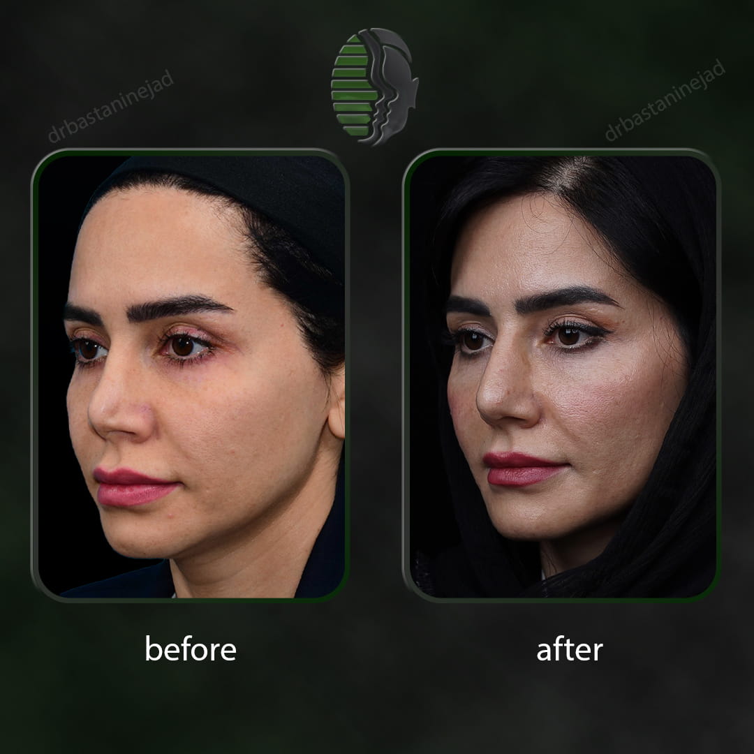عکس سه رخ بعد از جراحی بینی ترمیمی