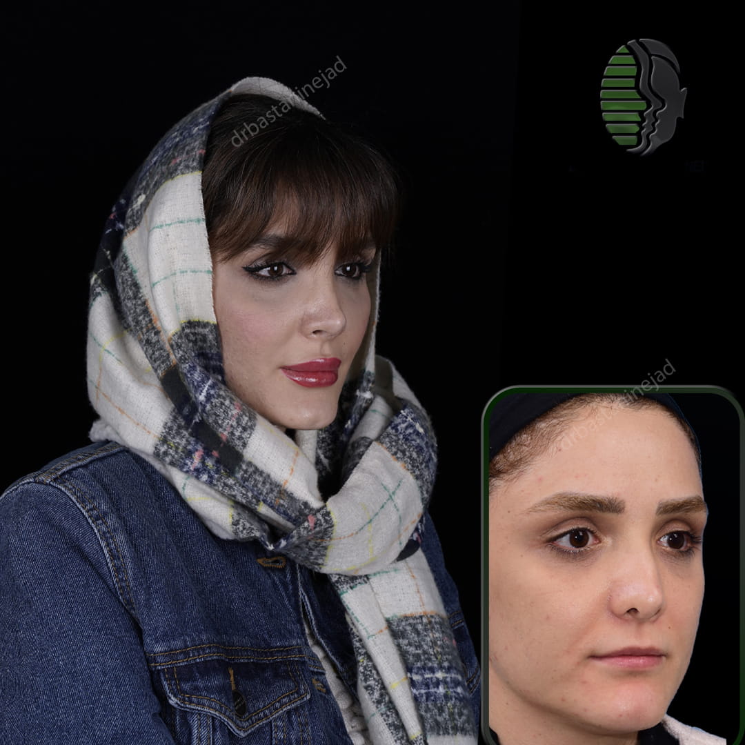 عکس قبل و بعد از عمل ترمیمی بینی بعد از 2 سال